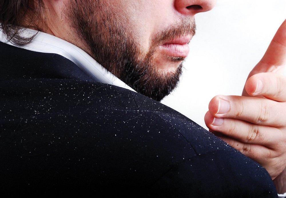 Как избавиться от перхоти в домашних условиях быстро и эффективно (народными средствами)?