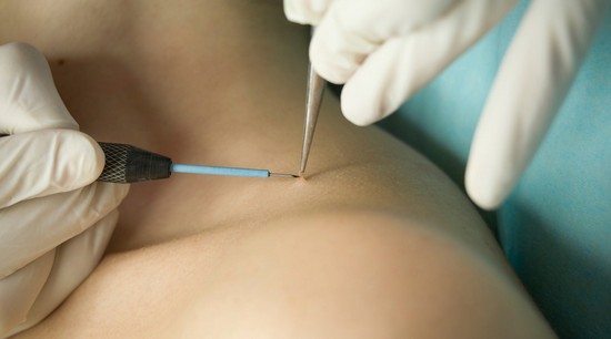 доктора советуют отказаться от лечения ангиом