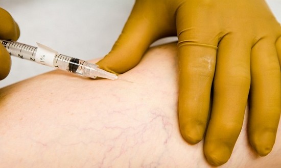 тромбоз глубоких вен нижних конечностей