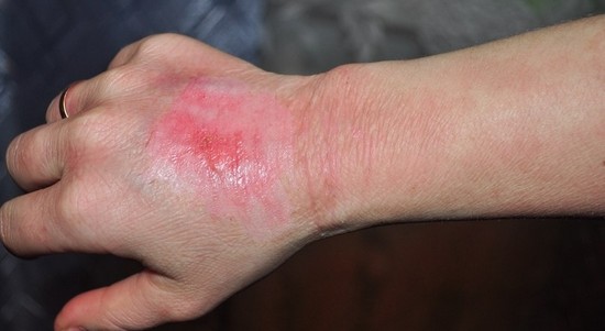 Мазь Траумель хорошо помогает от ожогов