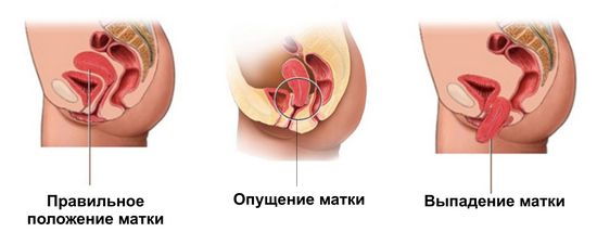 Опущение матки: симптомы и последствия, лечение