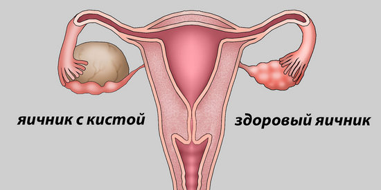 киста яичника